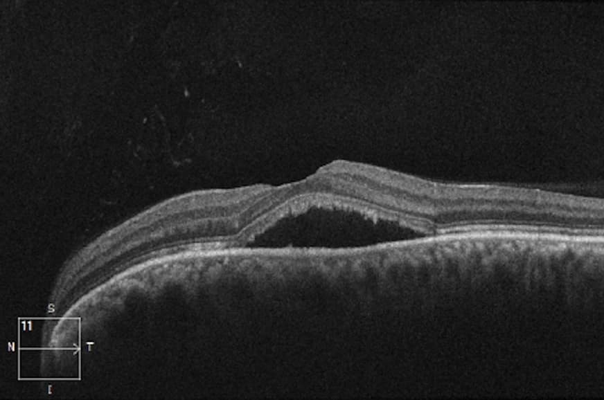 OCT showing detailed macular pathology with structural changes