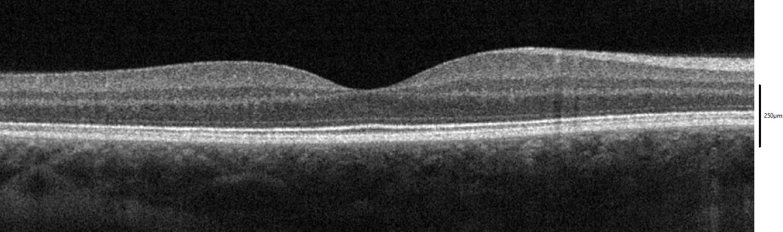 OCT cross-section showing normal macular anatomy with clearly defined retinal layers