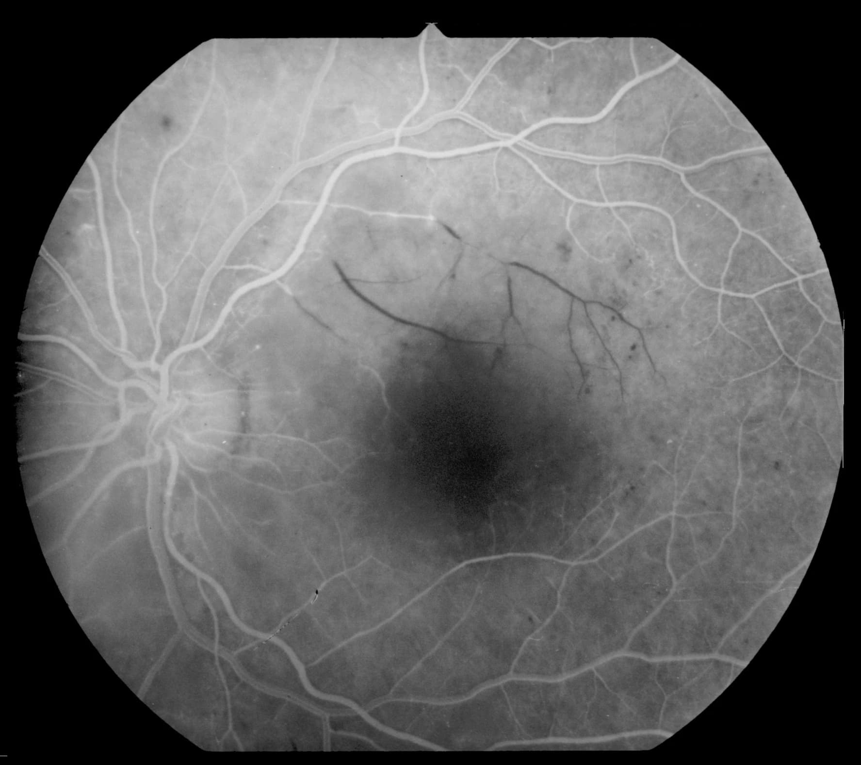 Retinal angiography showing vascular pathology and occlusion patterns
