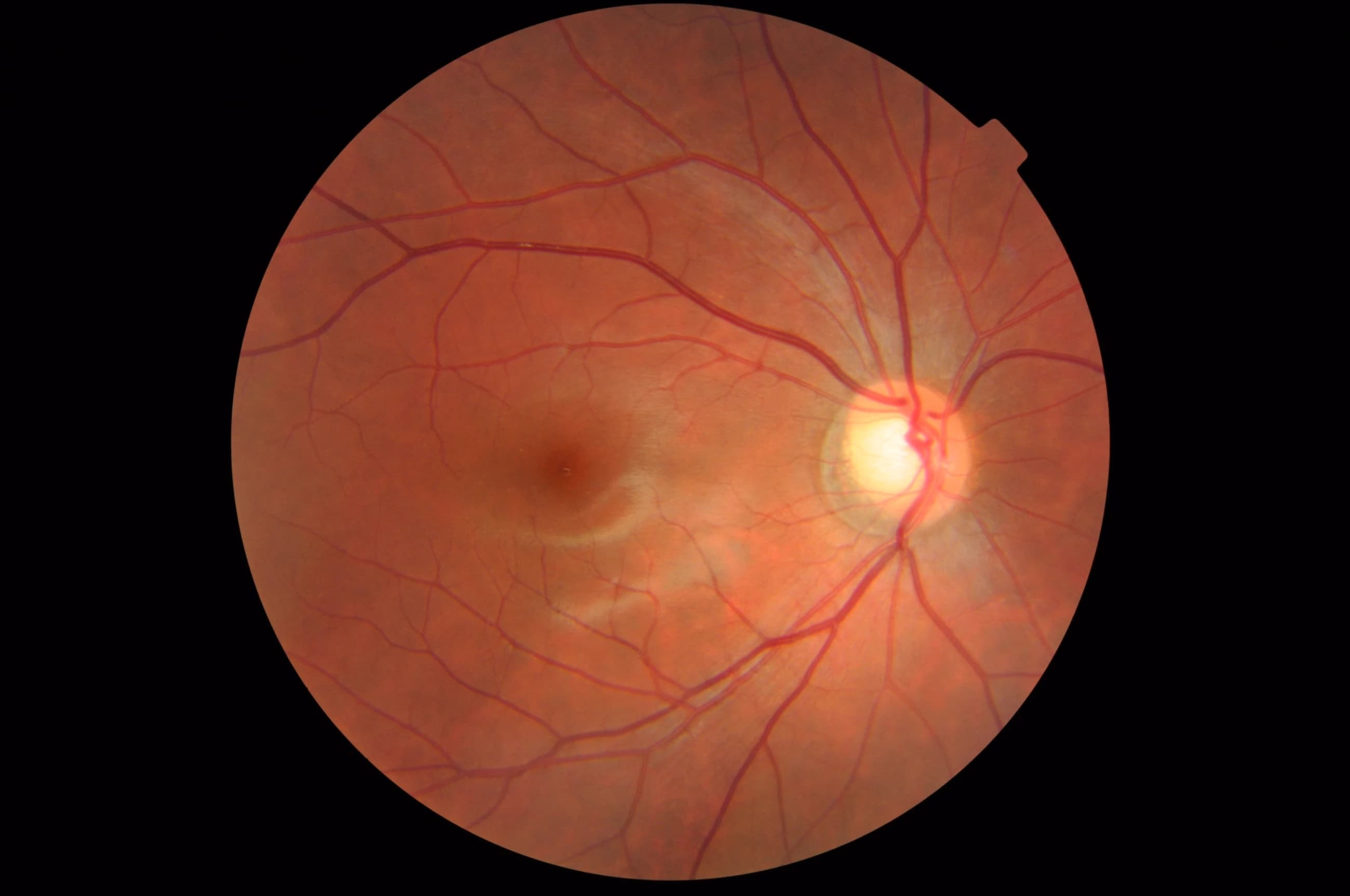 Fundus photograph showing healthy retinal anatomy with optic disc and vascular network