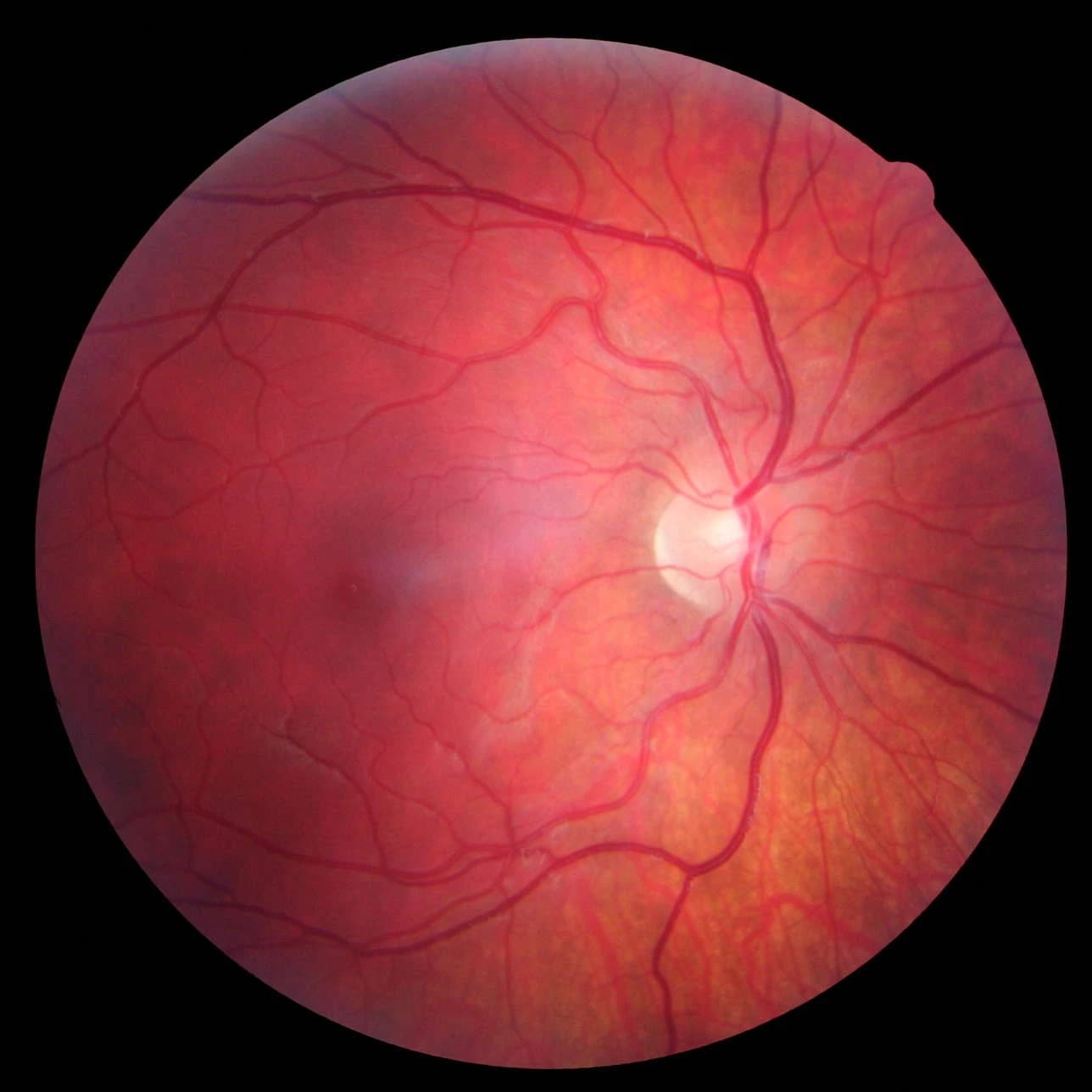 Detailed fundus photograph showing retinal vasculature and neural tissue